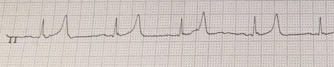 Lead II rhythm strip with tall peaked T waves consistent with hyperkalemia